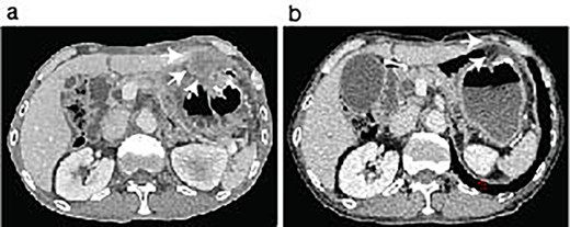 ICI therapy after the abdominal surgery. The patient showed peritoneal nodules (arrows) in the first follow-up CT scan after the last abdominal surgery (a). The peritoneal nodules were almost disappeared after 6 months following Pembrolizumab treatment (b, arrows).