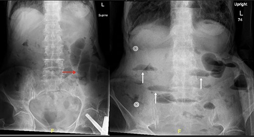 Supine and erect abdominal radiograph demonstrate distended small bowel loops (red arrow) with multiple air fluid levels (white arrow) suggesting small bowel obstruction.
