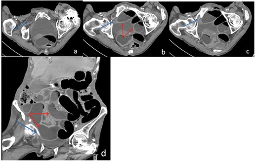 Axial (a–c) and Coronal (d) contrast-enhanced reformatted CT image of the abdomen shows distal ileal loop segment protrudes through the right obturator foramen with the herniated segment trapped between the right obturator externus and pectineus muscles (blue arrow), there is proximal upstream dilated small bowel loops (red arrows). In keeping with high-grade small bowel obstruction due to strangulated obturator hernia.