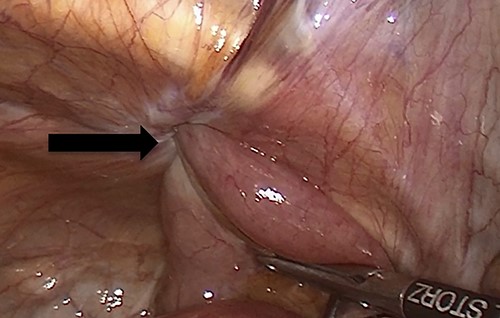 An intraoperative figure of the obturator hernia transitional zone revealing the hernial sac and protruded bowel segment.