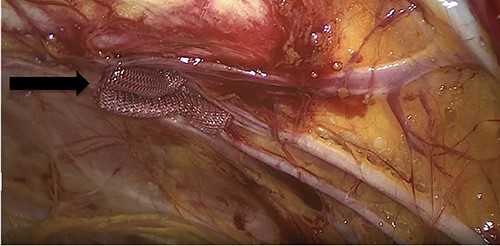 An intraoperative figure of the Vicryl mesh plug inserted into the obturator opening.