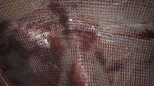 An intraoperative figure of the right ProGrip mesh covering the whole right area.