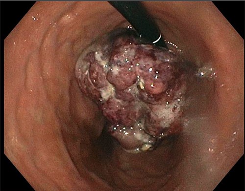 EGD showing stomach mass.