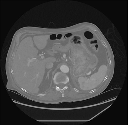 CT abdomen/pelvis with stomach mass.