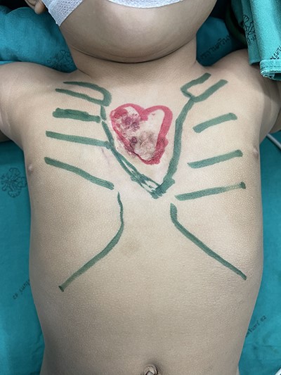 Preoperative marking.