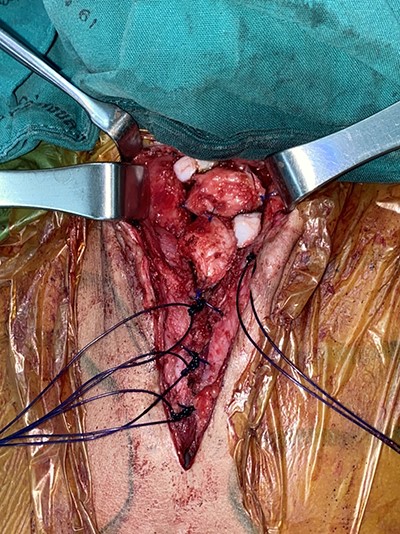 Autologous cartilage graft.