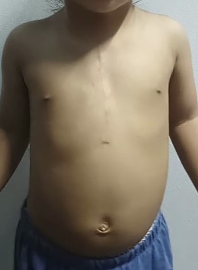 Postoperative follow up 6 months.