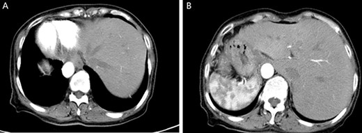 Enhanced CT of the upper abdomen showed that the heart was located on the right side of the thoracic cavity, the liver was located on the left side of the abdominal cavity (A), and the stomach and spleen were located on the right side of the abdominal cavity (B), confirming SIT.