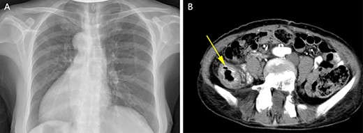Chest X-ray showed that the heart was on the right side of the chest (A). Enhanced CT of the lower abdomen showed thickening of the descending colon with stenosis and enhancement, which suggested that it might be a tumor of the descending colon (B, yellow arrow).