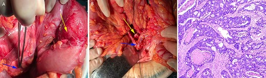 The left ovarian blood veins were significantly thickened (A, blue arrow), and the tumor was located in the descending colon (A, yellow arrow); the inferior mesenteric blood vessels were absent, the left colon blood vessels (B, blue arrow) and the left ureter (B, yellow arrow) were marked. Pathological examination showed a moderately differentiated adenocarcinoma (C).
