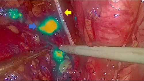 The blue arrow shows the lymph nodes which, due to the effect of indocyanine, take on a fluorescent green color. The yellow arrow indicates the obturator nerve.