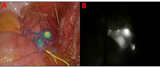 Panel (A) shows the lymph nodes in green color when the blue light is used. Panel (B) shows the lymph nodes in white when the ‘overlay’ function is used.