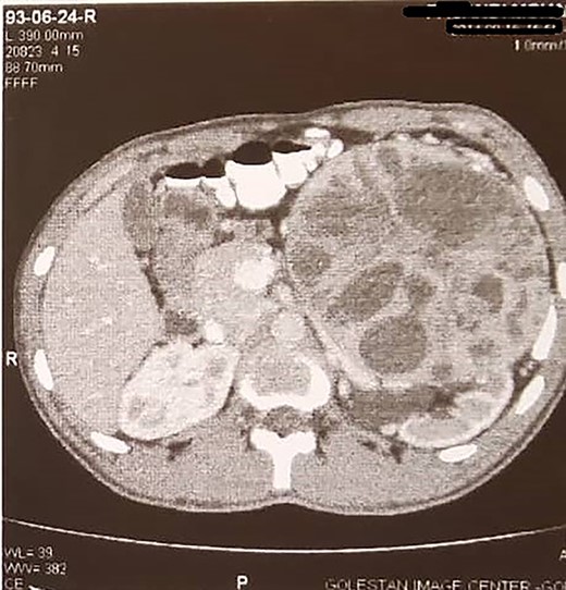 Large left renal mass.