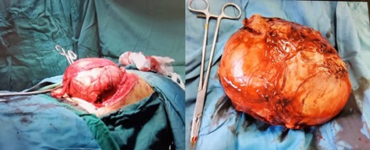 Huge renal mass during surgery and removed mass.