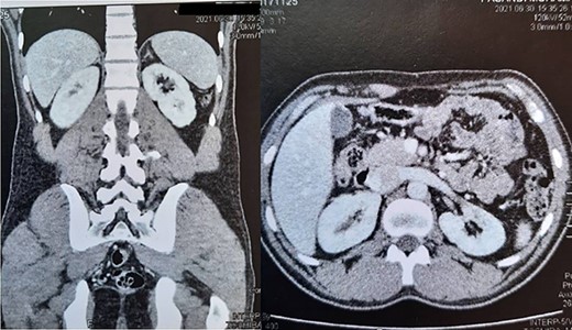 The follow-up image revealed normal-appearing left kidney.