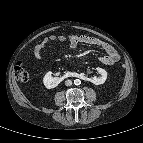 Axial CT (nephrographic phase).
