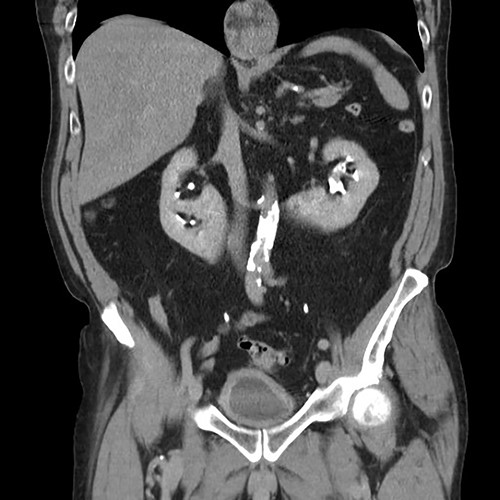 Coronal CT (urographic phase) demonstrating filling defect left upper pole.