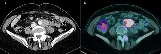 (a) Solid tissue enveloping the terminal portion of the abdominal aorta measuring approximately 45 × 26 × 81 mm in diameters; (b) fluorodeoxyglucose PET showing a pathological uptake with SUV of 10 at the level of the para-aortic lymphomatous tissue.