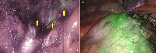 (a) Lymph nodes stained with ICG in the subserosa, surrounding the left iliac artery (yellow arrows); (b) the enhanced lymphomatous tumor after intravenous ICG administration at near-IR fluorescence vision.