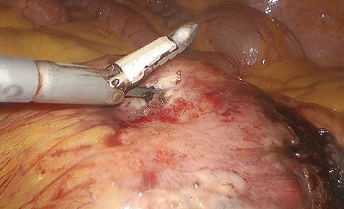 Incisional biopsy of the tumor realized by means of the Thunderbeat dissector.