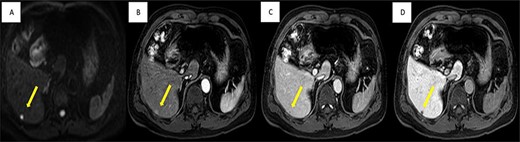 Imaging findings; MRI shows well-defined 6-mm nodule (yellow arrow), (A) strongly high signal intensity in diffusion-weight image, (C) slightly enhanced in arterial phase, (C) low signal intensity in portal phase and (D) non-uptake in hepatobiliary phase.