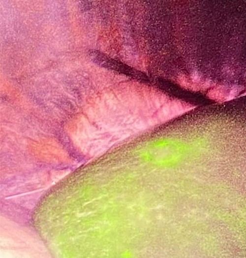 Intraoperative findings showed positive staining of ICG within tumour (the patient was in the left lateral decubitus position).