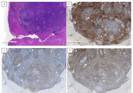 Histopathological findings; the microscopic of nodule shows lymphoid cells proliferation and lymphoid follicles formation with germinal centre (A); immunohistochemical results are as follows: CD3+ T cells (B), CD20+ B cells (C), BcL-2+ non germinal centre (D), Ki-67 (increased proliferation in germinal centres) and no restriction.