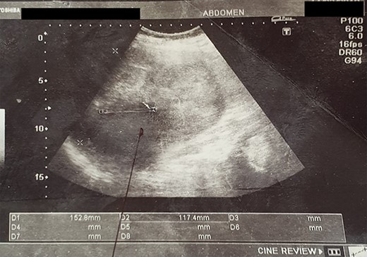 US image showing an altered echogenic left suprarenal lesion.