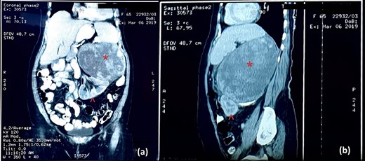 CT image: (a) coronal section and (b) sagittal section; the red asterisk mark in (a, b) shows the tumour and the red arrowhead in (a, b) shows the inferiorly displaced left kidney.