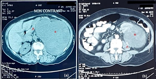 Cross-sectional image of computer tomogram; (a) non-contrasted image and (b) contrasted image; the red asterisk mark in (a, b) shows the tumour, the red arrowhead in (a) shows anteriorly displaced pancreas and the red arrowhead in (b) shows the clear distinction of tumour from the left psoas.