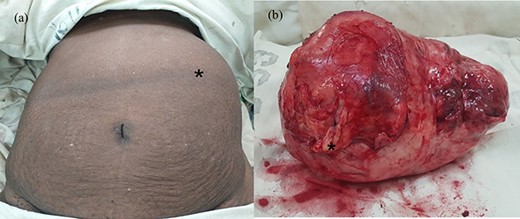(a) Abdomen of the patient after induction at operating room and (b) macroscopic appearance of the tumour with the thick capsule; the black asterisk mark in (a) shows the tumour occupying the left abdomen and in (b) depicts an area of thickening on the capsule corresponding to osseous metaplasia.