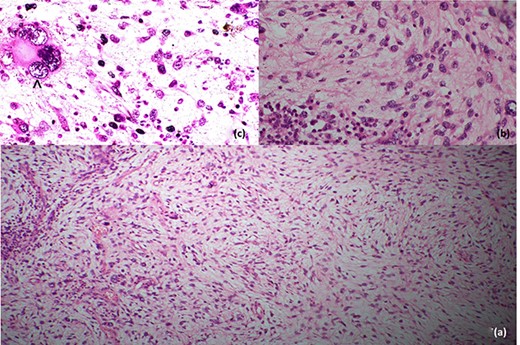 Histopathological features; (a) low-power image showing spindle cells in pleomorphic-storiform pattern, (b) high-power image showing spindle cells with bizarre multilobulated nuclei and (c) very high-power image depicting a nucleus in a spindle cell; the black arrowhead in (c) shows high mitotic activity in a spindle cell.