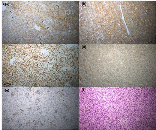 Immunohistochemical staining profile; (a) CD68-positive, (b) CD99-positive, (c) CD34-positive, (d) desmin-positive, (e) SMA-positive and (f) CD117-negative.
