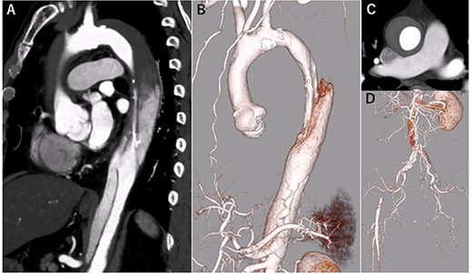 eCT at diagnosis. (A): Sagittal view, (B) 3D reconstruction of the ascending and descending aorta, (C): Axial view of the ascending aorta and (D): 3D reconstruction of the abdominal aorta and iliac artery.
