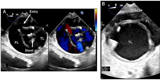 TEE during the operation. (A): At entry site. Entry and stent grafts are shown. FL, false lumen; TL, true lumen. (B): Expansion of the TL.