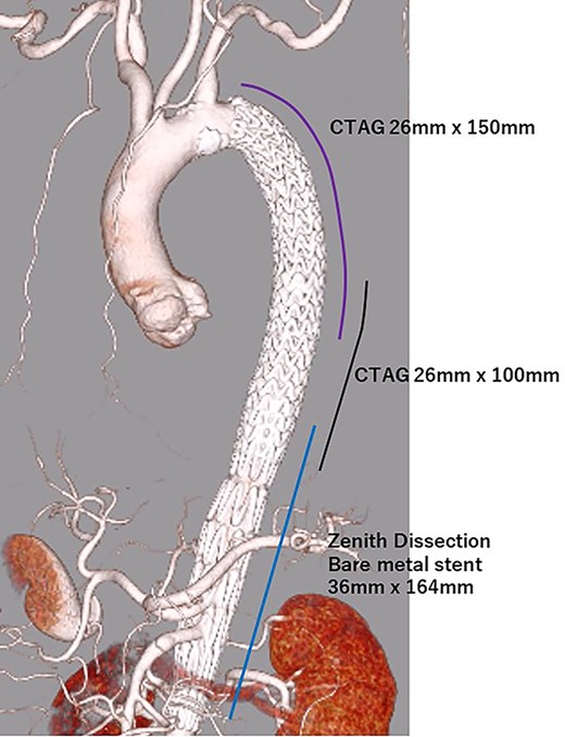eCT at 1-day postoperatively.