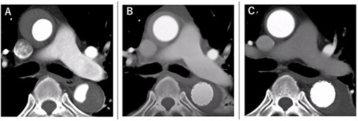 The course of aortic remodeling at the ascending aorta. (A): Preoperative, (B): 1-day postoperatively, (C): 11-day postoperatively (see Video 1).