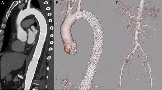 eCT at 11 days postoperatively. (A): Sagittal view, (B, C): 3D reconstruction of the aorta.