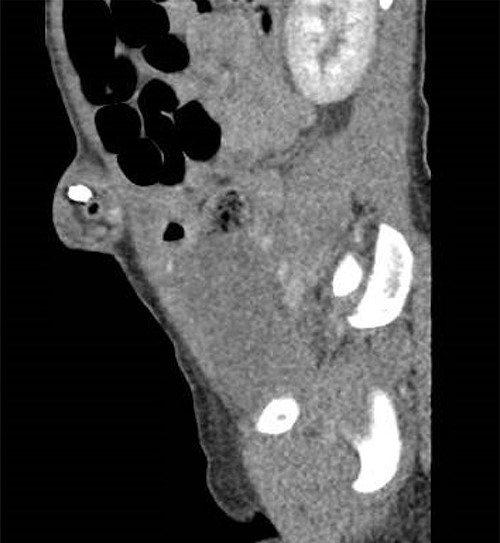Sagittal view showing presence of umbilical hernia.