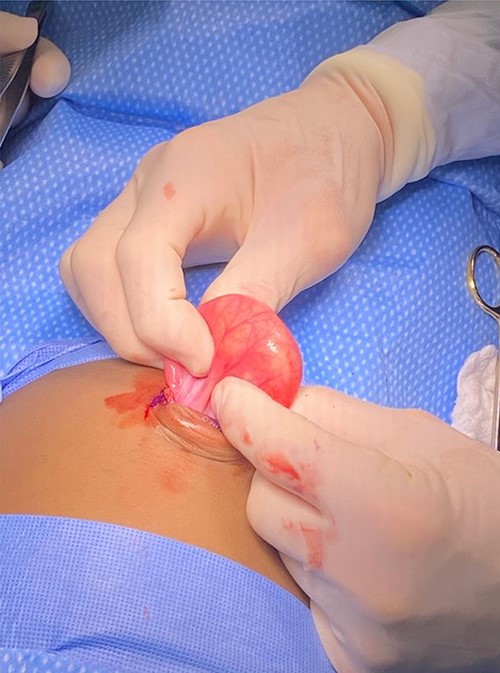 A large mass protruding from the umbilicus.