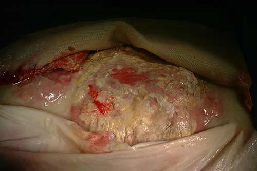Open abdomen with Wittmann patch management.