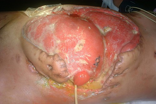 Management with aspiration probes and placement of Goretex™ mesh.
