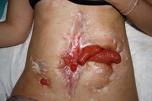 Abdomen closed by secondary intention with eviscerated loops and enteroatmospheric fistulae (front view).