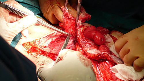 Intraoperative image of monobloc resection of enterocutaneous fistulas in reconstruction surgery.