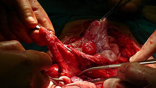 Intraoperative image of monobloc resection of enterocutaneous fistulas in reconstruction surgery.