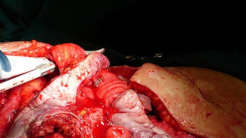 Intraoperative image of monobloc resection of enterocutaneous fistulas in reconstruction surgery.