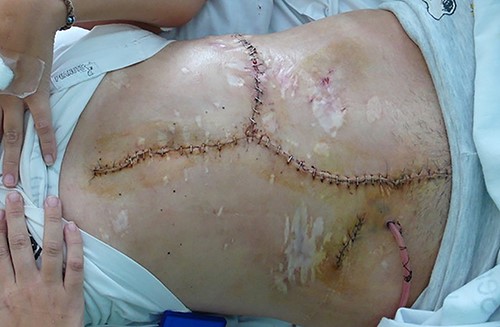 Immediate postoperative abdominal reconstruction.