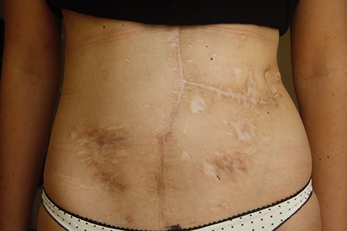 Appearance of the abdomen 12 years after reconstruction.