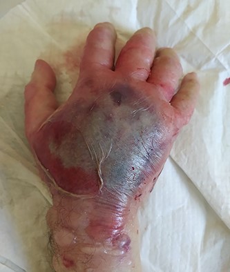 Swollen, paleness, erythematous and tense hand with skin blistering on dorsal aspect following extravasation of iodinated contrast agent.