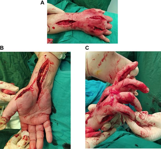 (A) Dorsal decompression of the dorsal interosseous and antebrachium compartments. (B) Thenar and carpal canal decompression. (C) Hypothenar decompression along with digit release via ulnar longitudinal incision of each finger.